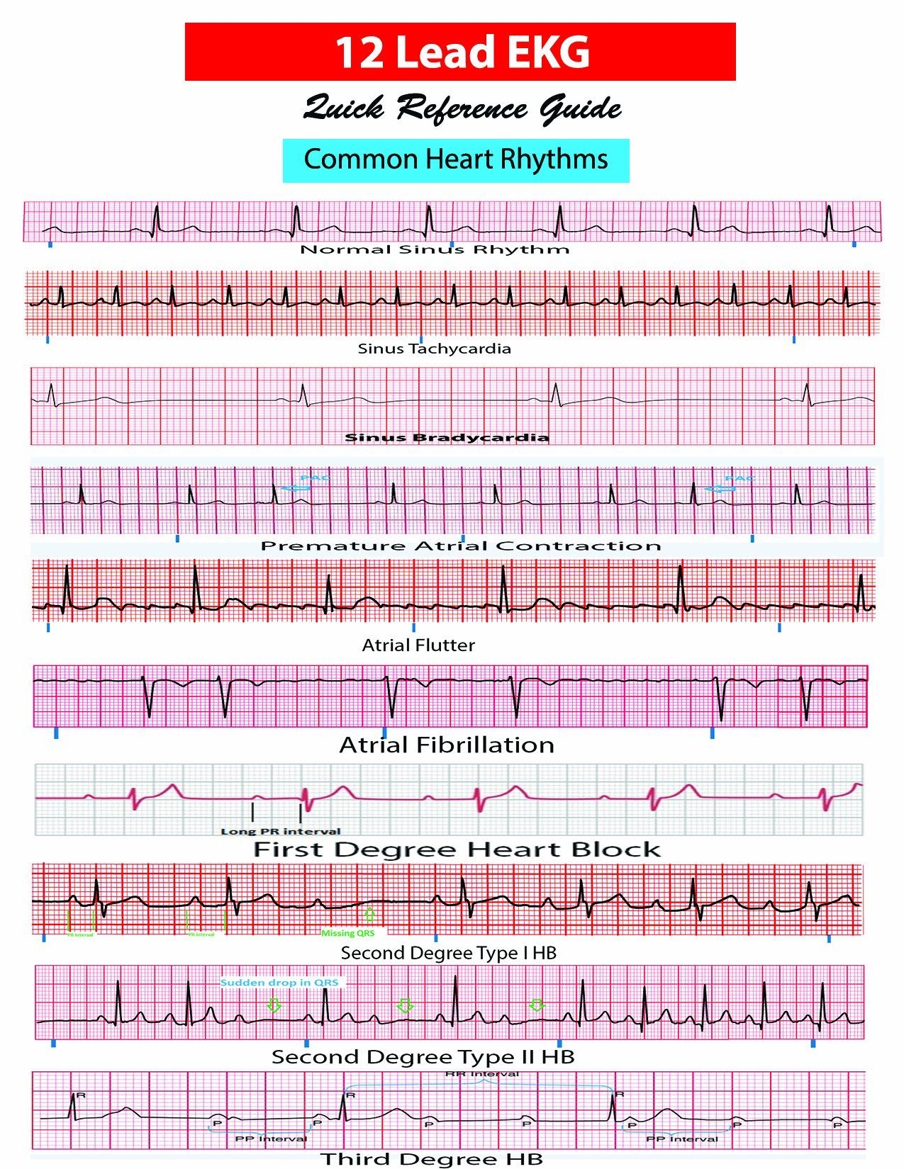 12 Lead EKG Pocket Card APRN World 9781941004067 Amazon Books