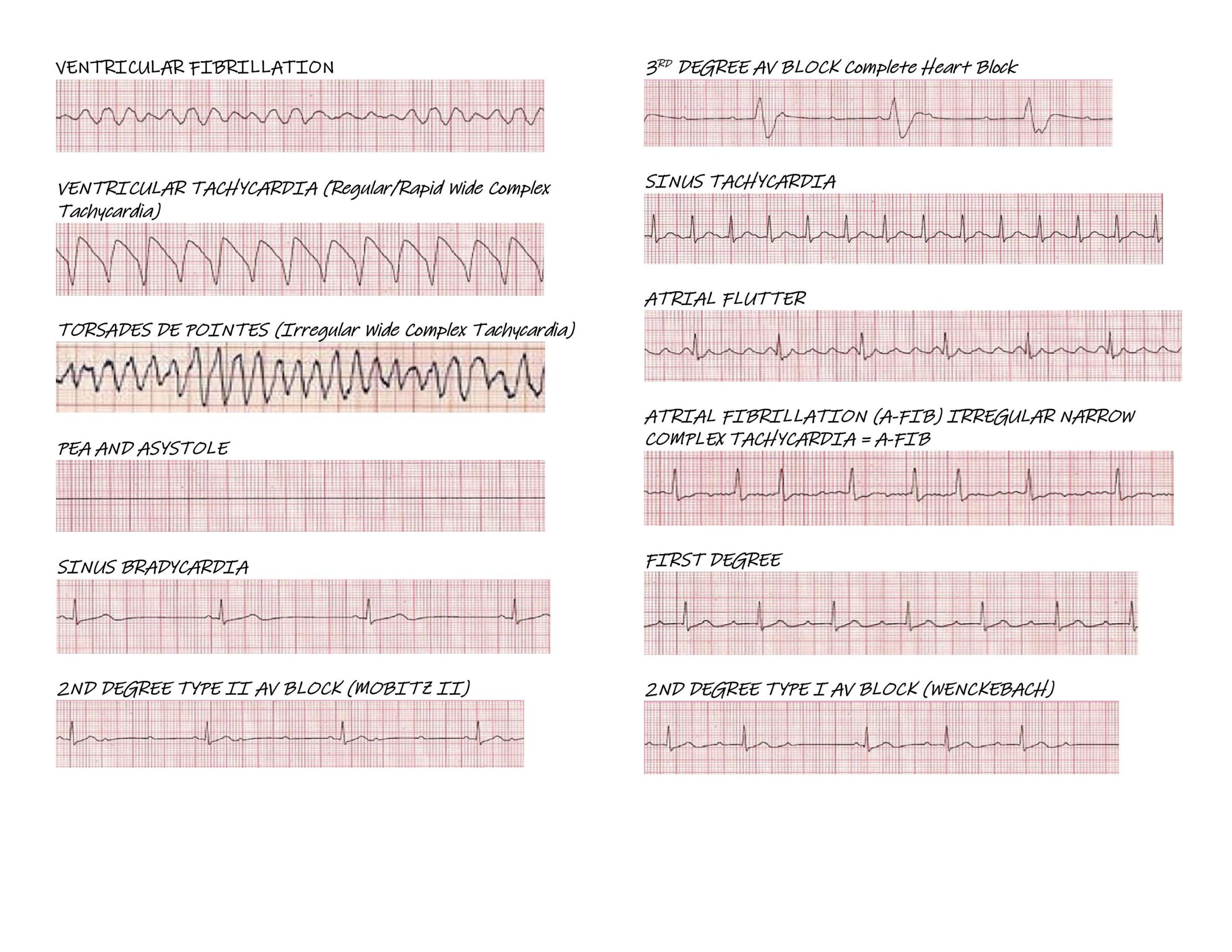 printable ekg rhythm strips