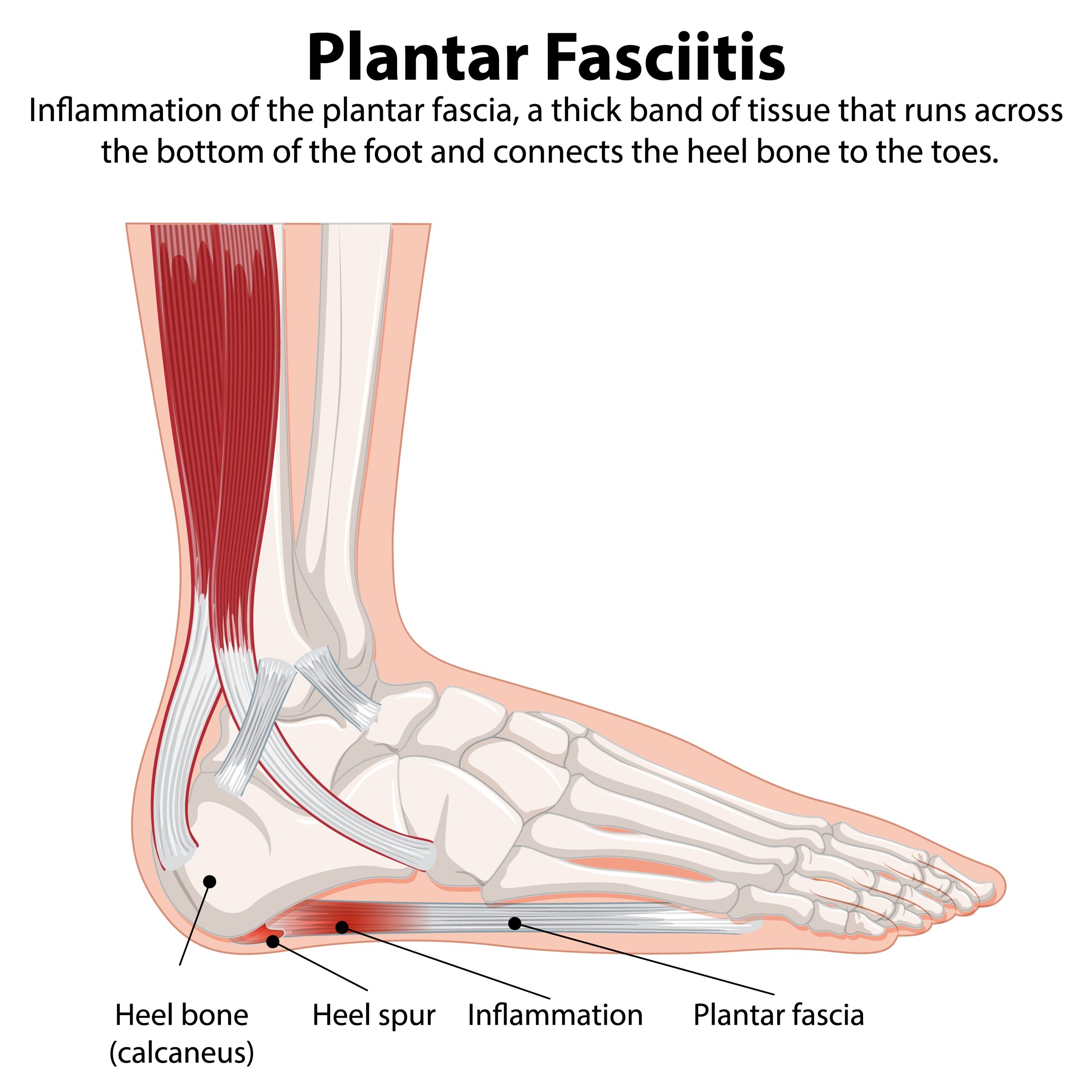 Shockwave Therapy For Plantar Fasciitis Effective Relief For 